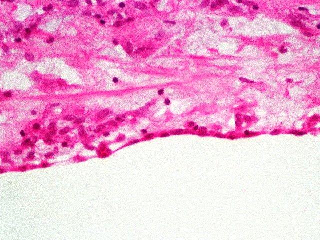 Figura 3. - Superficie tumoral con clulas mixoma poligonales y aplanadas. Hematoxilina & eosina, 40x.